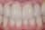 Veneer2